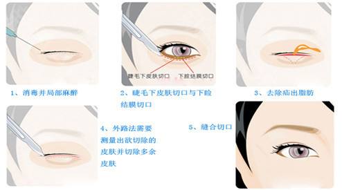 內(nèi)切祛眼袋比較適合哪些人做？手術(shù)要拆線嗎？