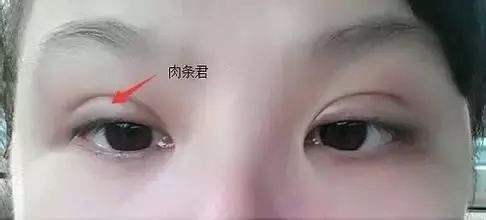 避免失敗！雙眼皮手術(shù)如何避免出現(xiàn)“肉條”？