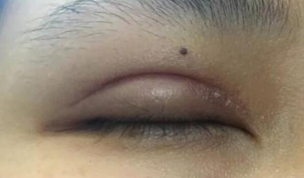 避免失??！雙眼皮手術(shù)如何避免出現(xiàn)“肉條”？