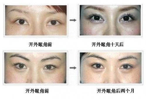 開眼角手術(shù)哪里好？開眼角不留疤的神秘黃金法則