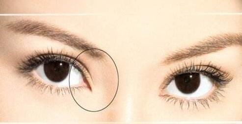 多少毫米的雙眼皮是zui好看的？想要?dú)W式雙眼皮需要割幾毫米？