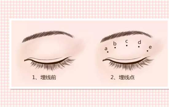 為什么不建議做埋線雙眼皮？它真的不持久！