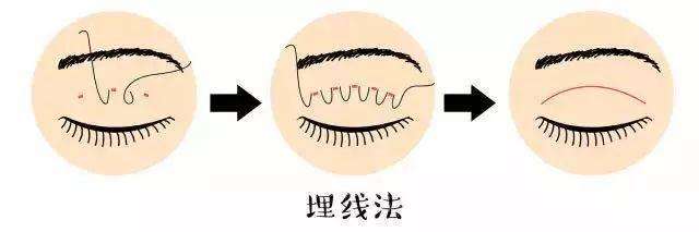 為什么不建議做埋線雙眼皮？它真的不持久！