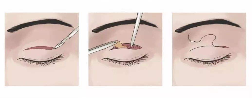 雙眼皮真是案例及干貨分享，看看眼睛對(duì)人顏值的影響！