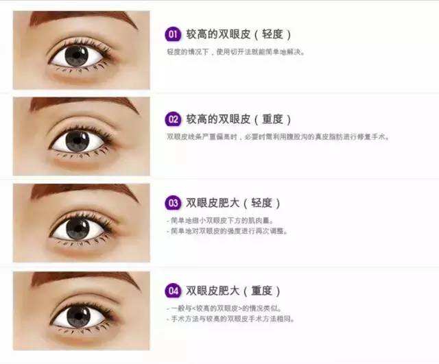 雙眼皮真是案例及干貨分享，看看眼睛對(duì)人顏值的影響！