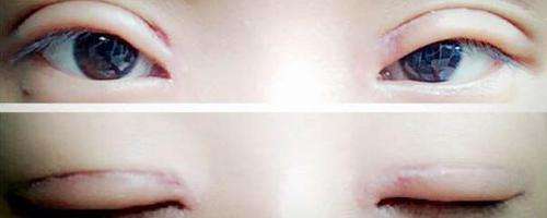 避免雙眼皮術(shù)后肉條給自己加戲！術(shù)后這些注意事項(xiàng)要做好~