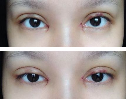 避免雙眼皮術(shù)后肉條給自己加戲！術(shù)后這些注意事項(xiàng)要做好~