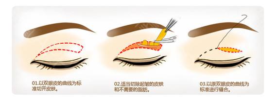你的眼睛也有“蒙古褶”嗎？內(nèi)眥贅皮矯正術(shù)可以了解一下