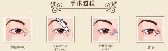 你的眼睛也有“蒙古褶”嗎？內(nèi)眥贅皮矯正術(shù)可以了解一下