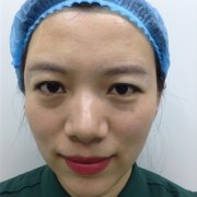 做了提眉15天啦！雙眼確實顯得精氣神許多~