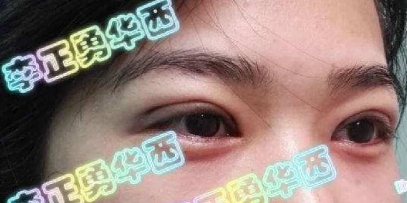 華西醫(yī)院李正勇醫(yī)生雙眼皮案例圖
