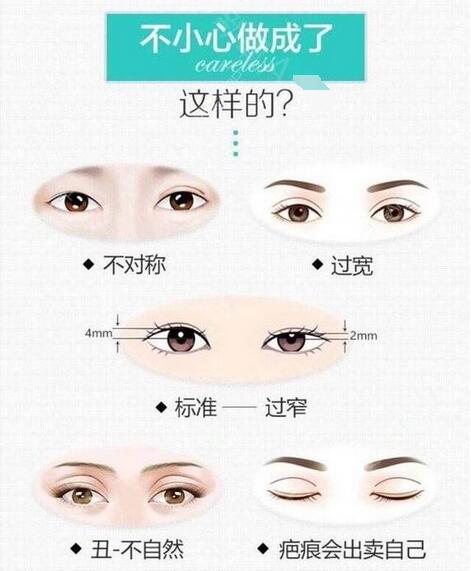 雙眼皮失敗修復(fù)手術(shù)