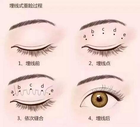 雙眼皮好醫(yī)生手術(shù)果更好，維護(hù)時(shí)間更長(zhǎng)，而普通醫(yī)生手術(shù)不仔細(xì)