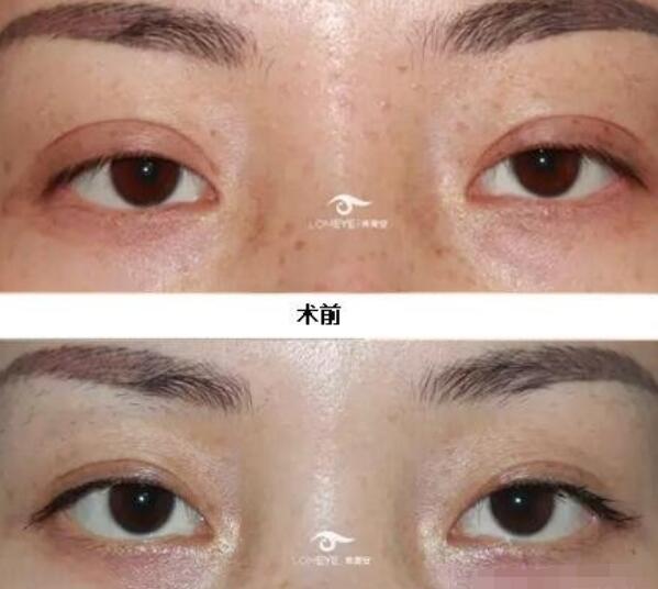 中日友好醫(yī)院高占巍醫(yī)生雙眼皮修復(fù)案例圖