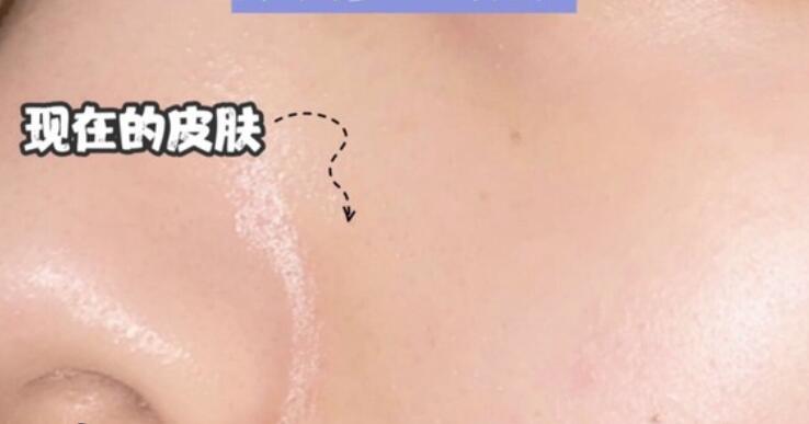 果酸去黑頭果圖