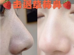 一療程果酸去黑頭的果，順便講講你們對黑頭的誤區(qū)！