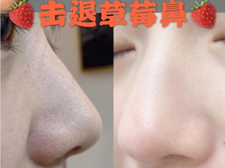 果酸去黑頭果圖