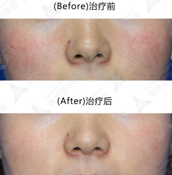 去除紅血絲果對(duì)比圖