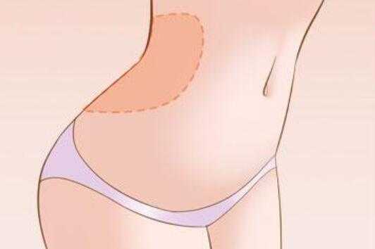 臀部吸脂手術(shù)中用到的設(shè)備不一樣，費(fèi)用也不一樣