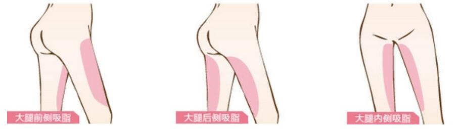 術者做完大腿吸脂手術后，并不是一勞永逸
