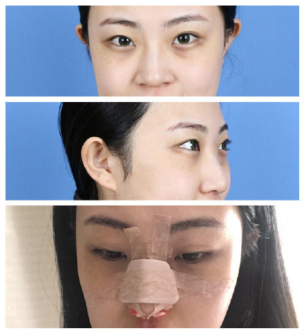長春銘醫(yī)整形隆鼻案例圖