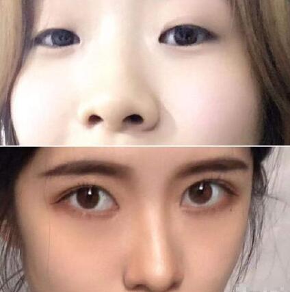 埋線雙眼皮手術(shù)調(diào)節(jié)的整體果圖及全過程分析圖