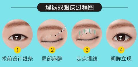 埋線雙眼皮手術(shù)全過程分析圖