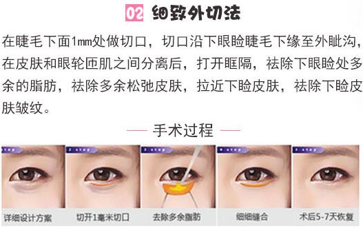小小年紀(jì)就會(huì)有祛眼袋？外切做眼袋手術(shù)確實(shí)需要認(rèn)識(shí)下！