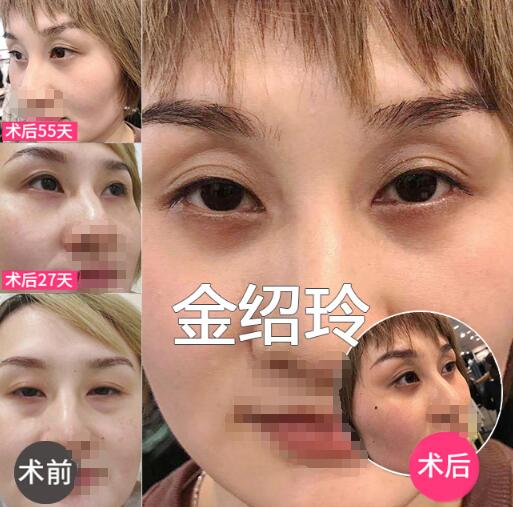 小小年紀(jì)就會(huì)有祛眼袋？外切做眼袋手術(shù)確實(shí)需要認(rèn)識(shí)下！