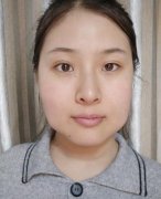 初次整形手術(shù)體驗(yàn)?zāi)ス鞘中g(shù)前后帶來的巨大改變！