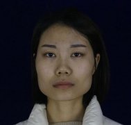 磨腮削骨手術(shù)后的果，再也沒(méi)人說(shuō)我“國(guó)字臉”了！