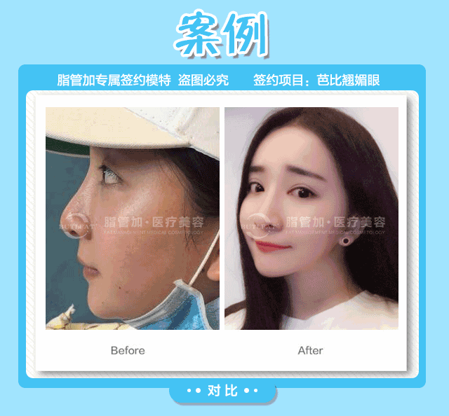 俞富興醫(yī)生脂肪填充案例圖