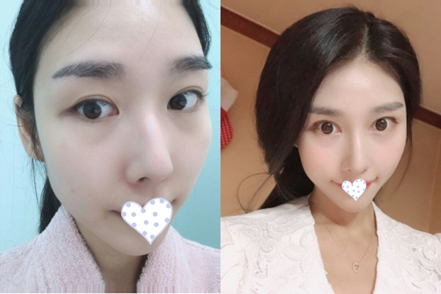 韓國,韓辰整形,醫(yī)院,口碑,雙眼皮,實(shí)例圖,