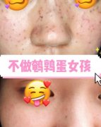 像素激光去痘做了后現(xiàn)已6個(gè)月左右了，無瑕皮膚