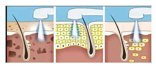 皮膚美容：彩光嫩膚和光子嫩膚有什么區(qū)別？哪個更好？