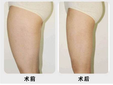 小腿吸脂減肥有什么風(fēng)險？果好嗎？