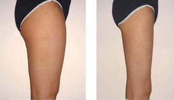 小腿吸脂減肥有什么風(fēng)險？果好嗎？