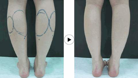 小腿吸脂減肥有什么風(fēng)險？果好嗎？