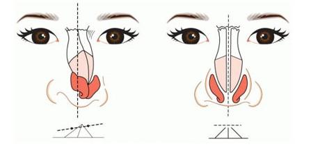 假體隆鼻失敗修復手術(shù)有哪些方法？