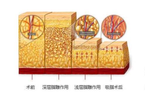 吸脂注意事項——這些事情做好，果事半功倍