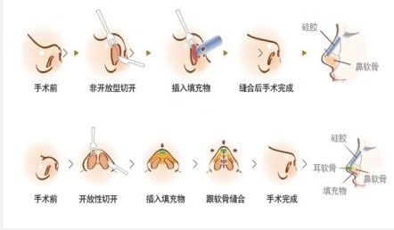 鼻翼縮小手術(shù)恢復(fù)期間應(yīng)該注意的這些事兒~