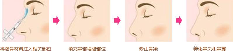 北京注射隆鼻多少錢？哪個(gè)品牌的玻尿酸隆鼻果好？