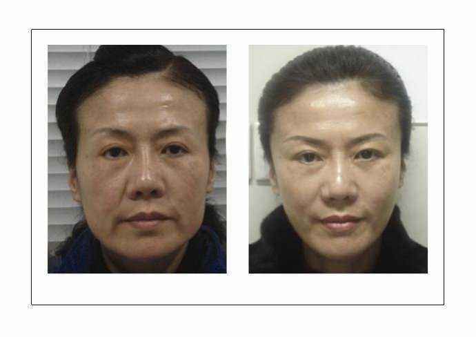 鼻唇溝填充能維持多久？可以選擇哪些材料？