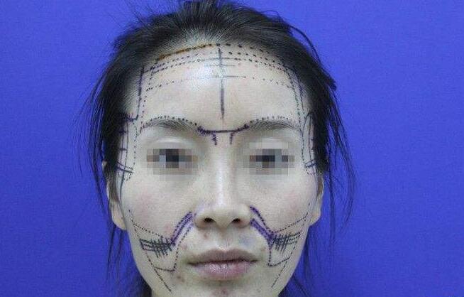 鼻唇溝填充能維持多久？可以選擇哪些材料？