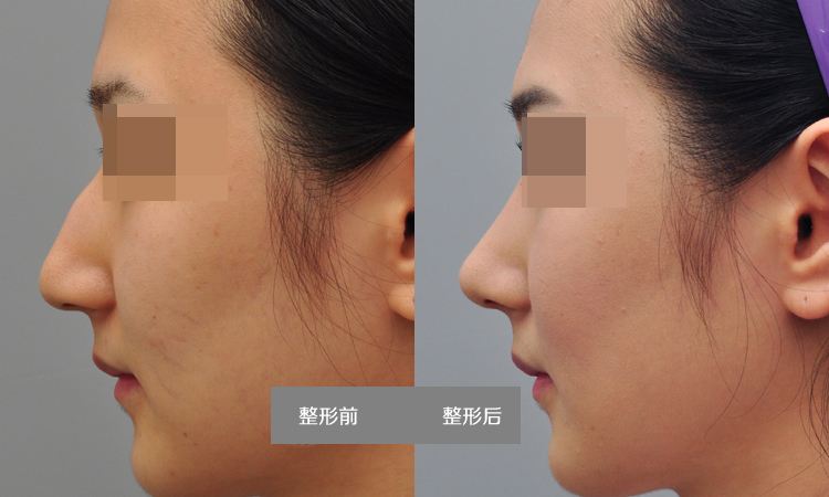 駝峰鼻矯正多少錢？駝峰鼻矯正術(shù)的幾種方法