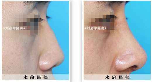 駝峰鼻矯正多少錢？駝峰鼻矯正術(shù)的幾種方法