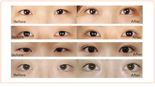 汕頭割雙眼皮哪家醫(yī)院好？名單送上請(qǐng)查收