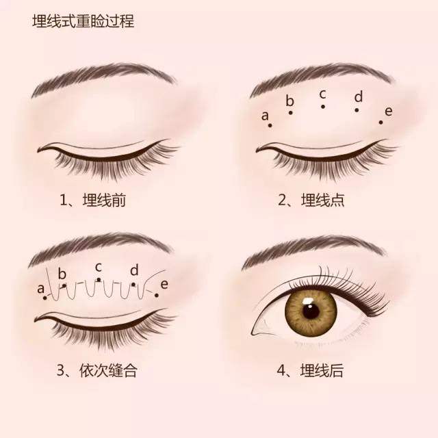 北京埋線雙眼皮修復(fù)哪些醫(yī)生技術(shù)好？