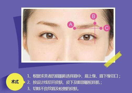 切眉術(shù)適合多大的年齡做？主要能帶來哪些果？