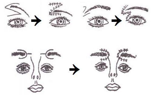 切眉術(shù)適合多大的年齡做？主要能帶來哪些果？